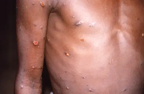 CDC/BRIAN W.J. MAHY Paciente com lesões na pele provocadas pela varíola do macaco, na República Democrática do Congo